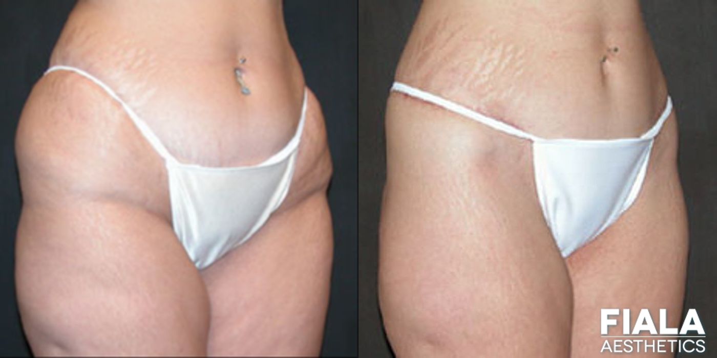 Tummy Tuck - Thumbnail 2