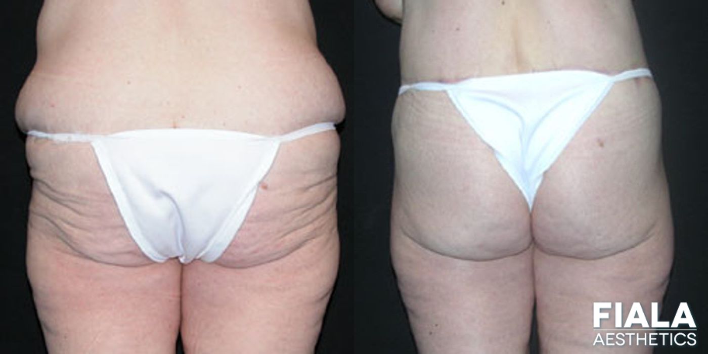 Before and after Body Lift case 13796