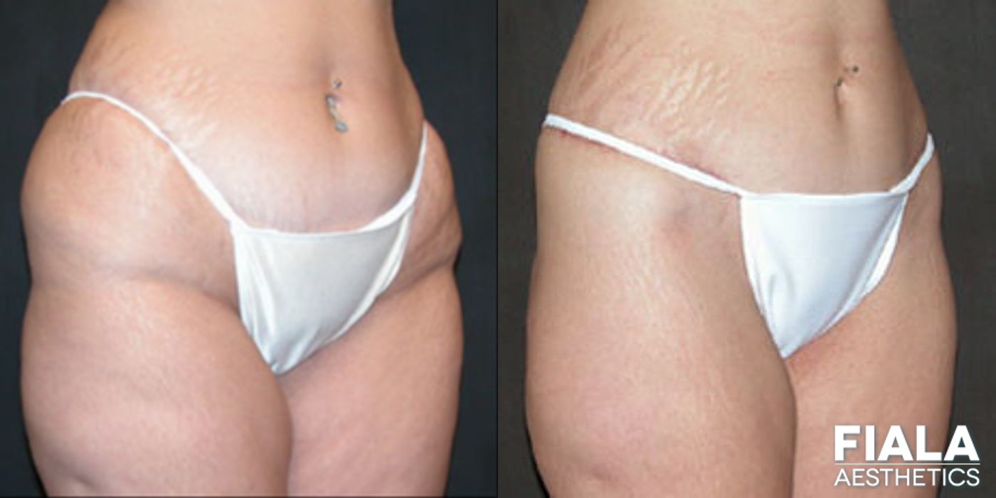 Before and after Tummy Tuck case 13798 - Angle 2
