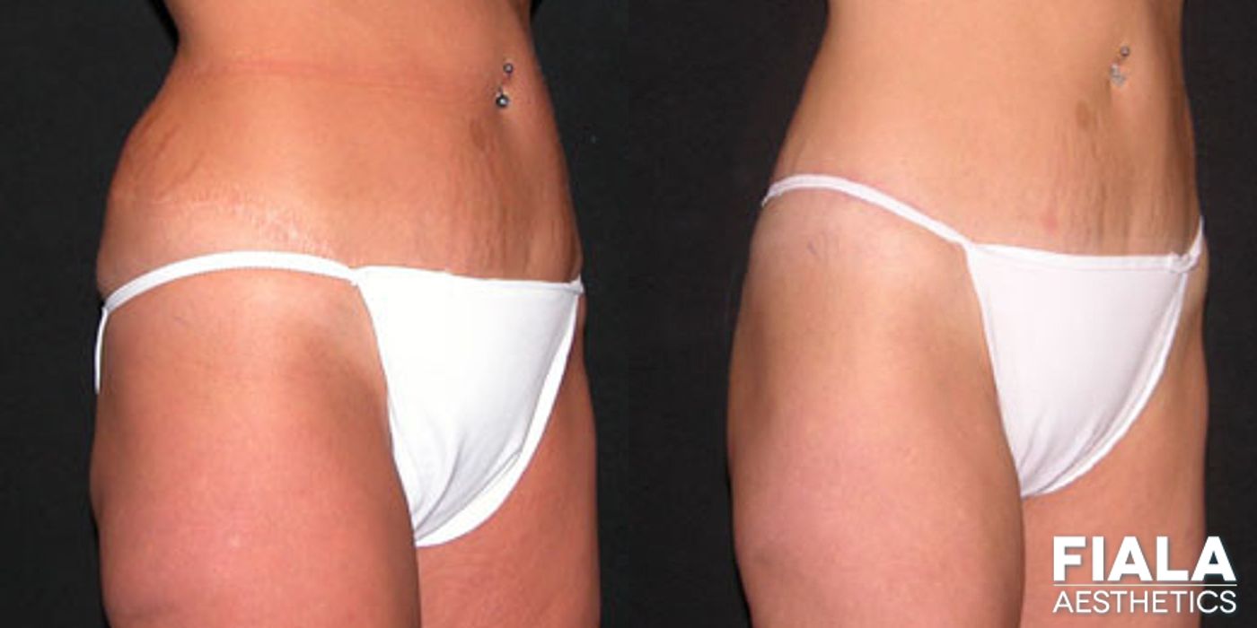 Before and after Body Lift case 13793
