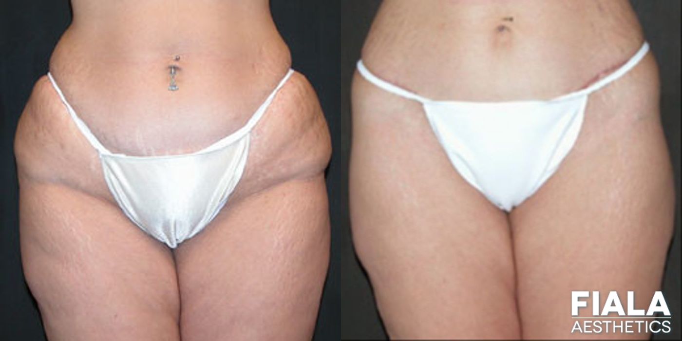 Before and after Tummy Tuck case 13798