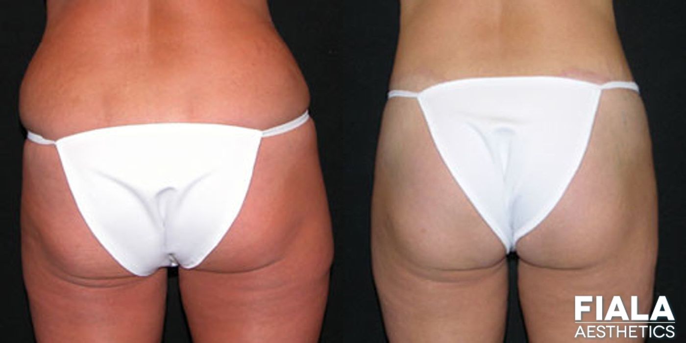 Body Lift - Thumbnail 2