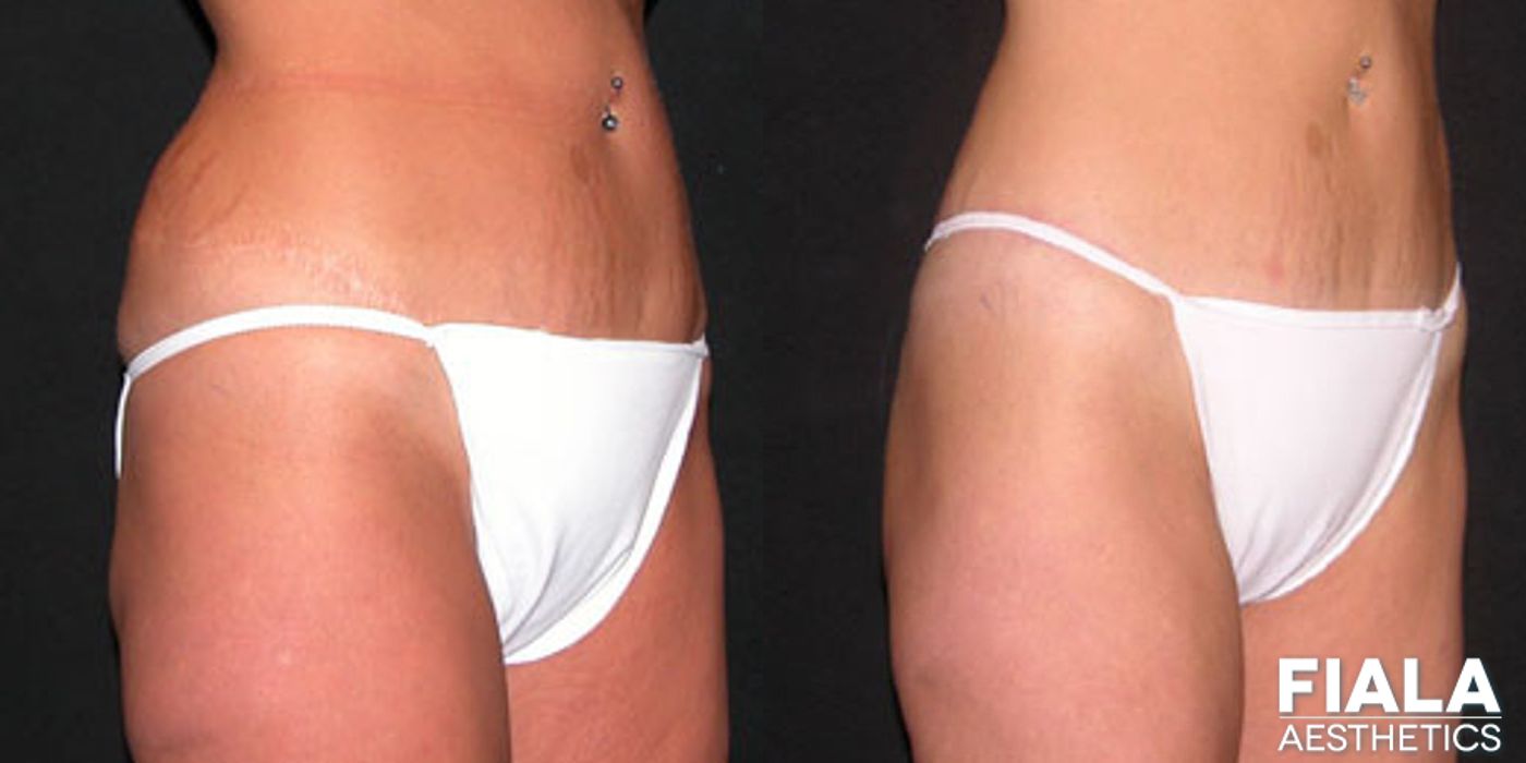 Body Lift - Case 9050