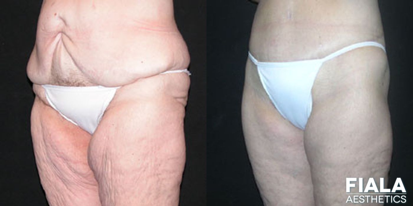 Body Lift - Thumbnail 2