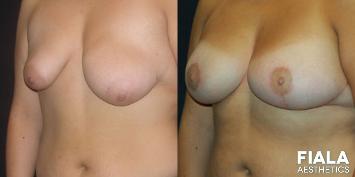 Before and after Breast Lift case 14000 - Angle 2