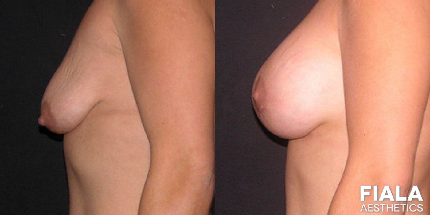 Breast Lift - Thumbnail 2