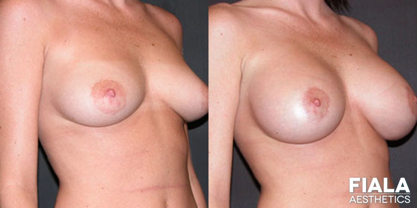Before and after Breast Lift case 13750