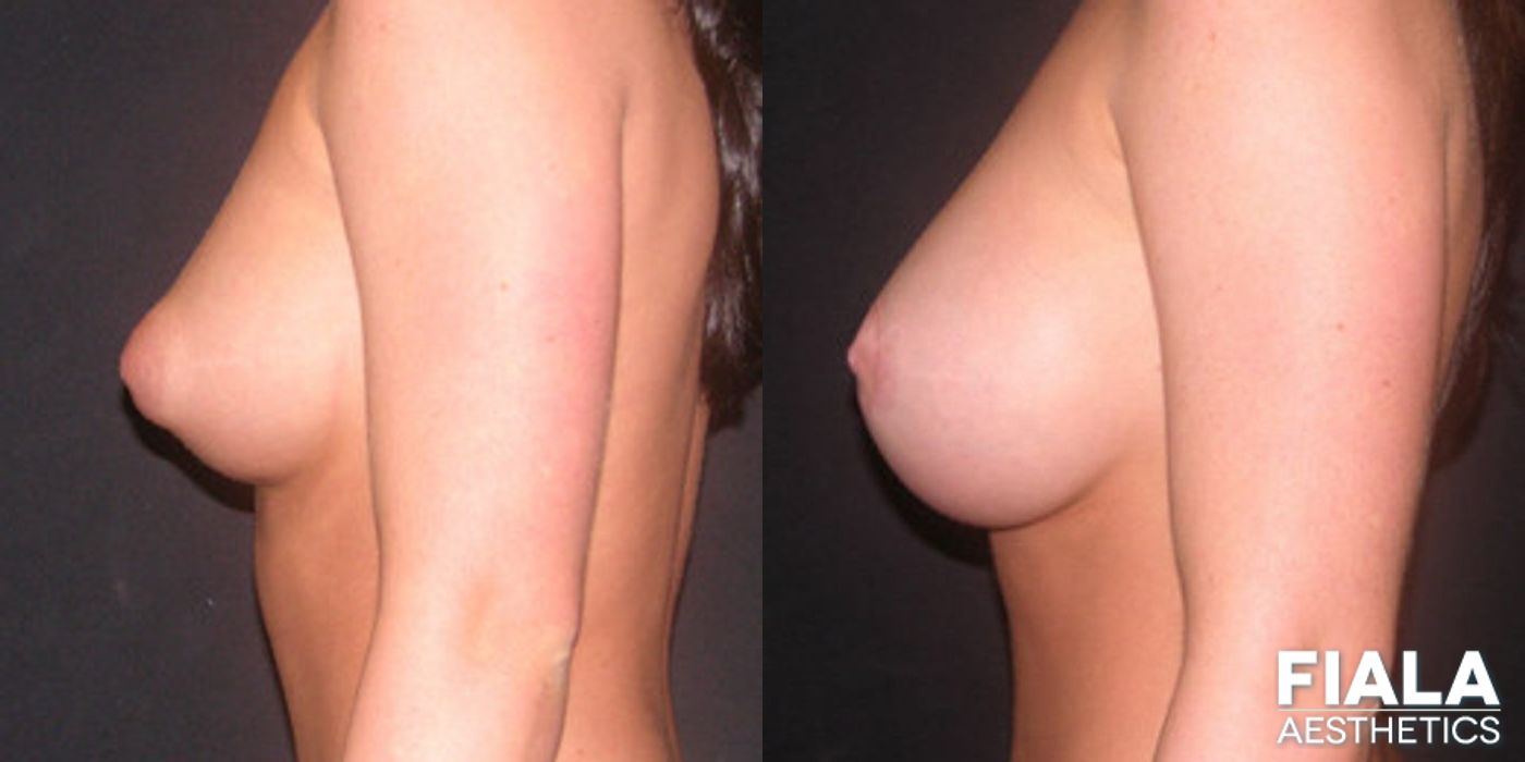 Before and after Breast Lift case 13734 - Angle 2