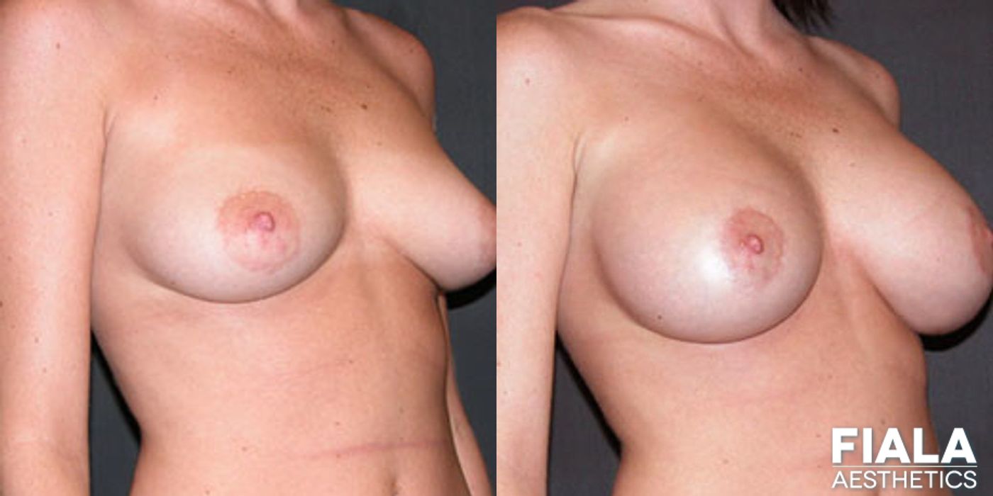Breast Lift - Case 9174