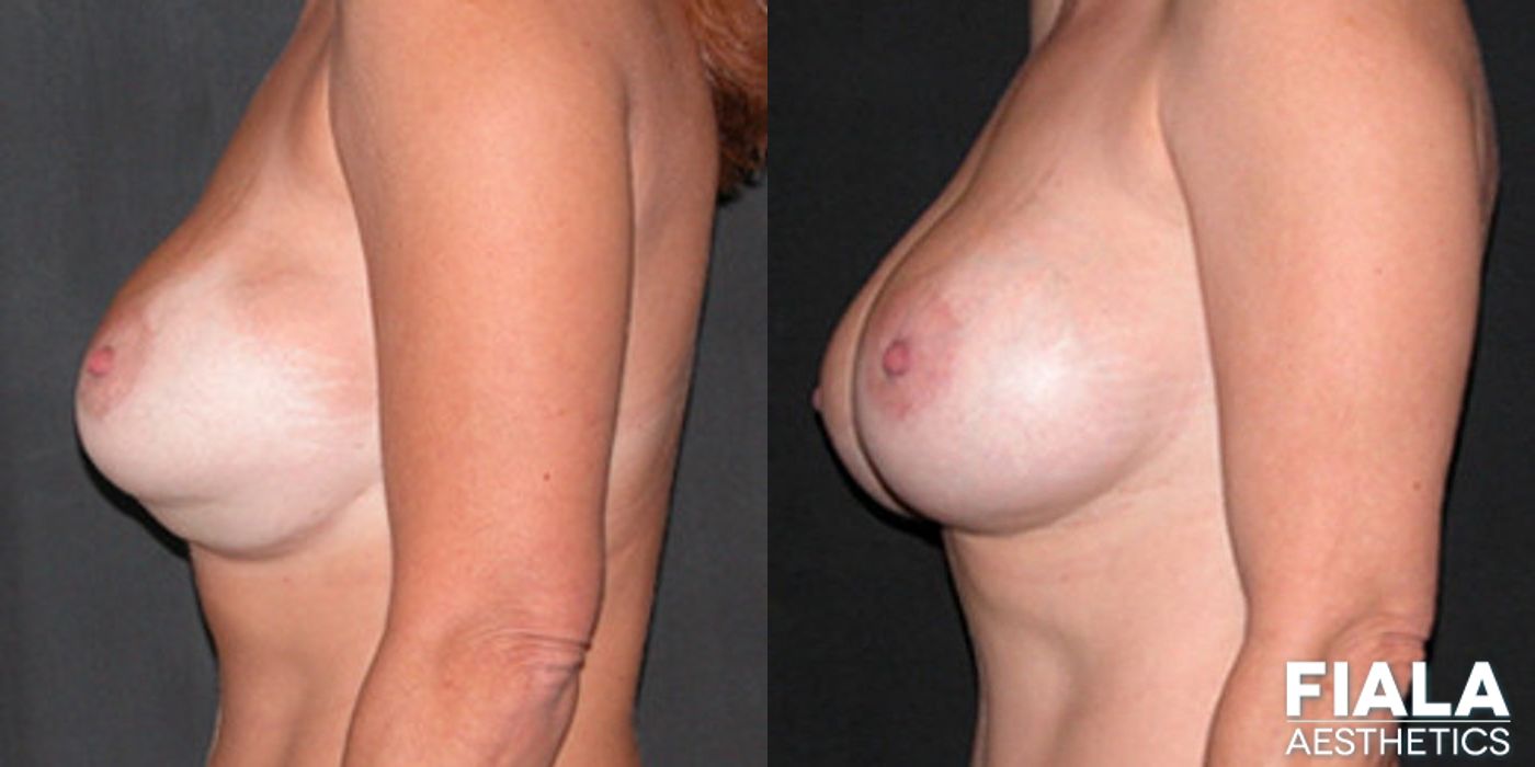 Breast Lift - Thumbnail 2
