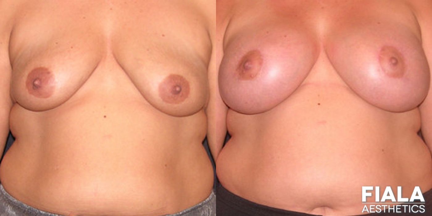Breast Lift - Case 9161