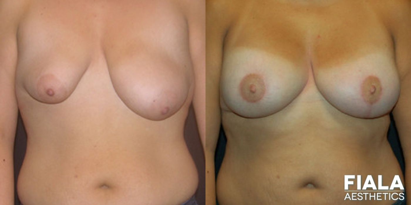 Before and after Breast Lift case 14000