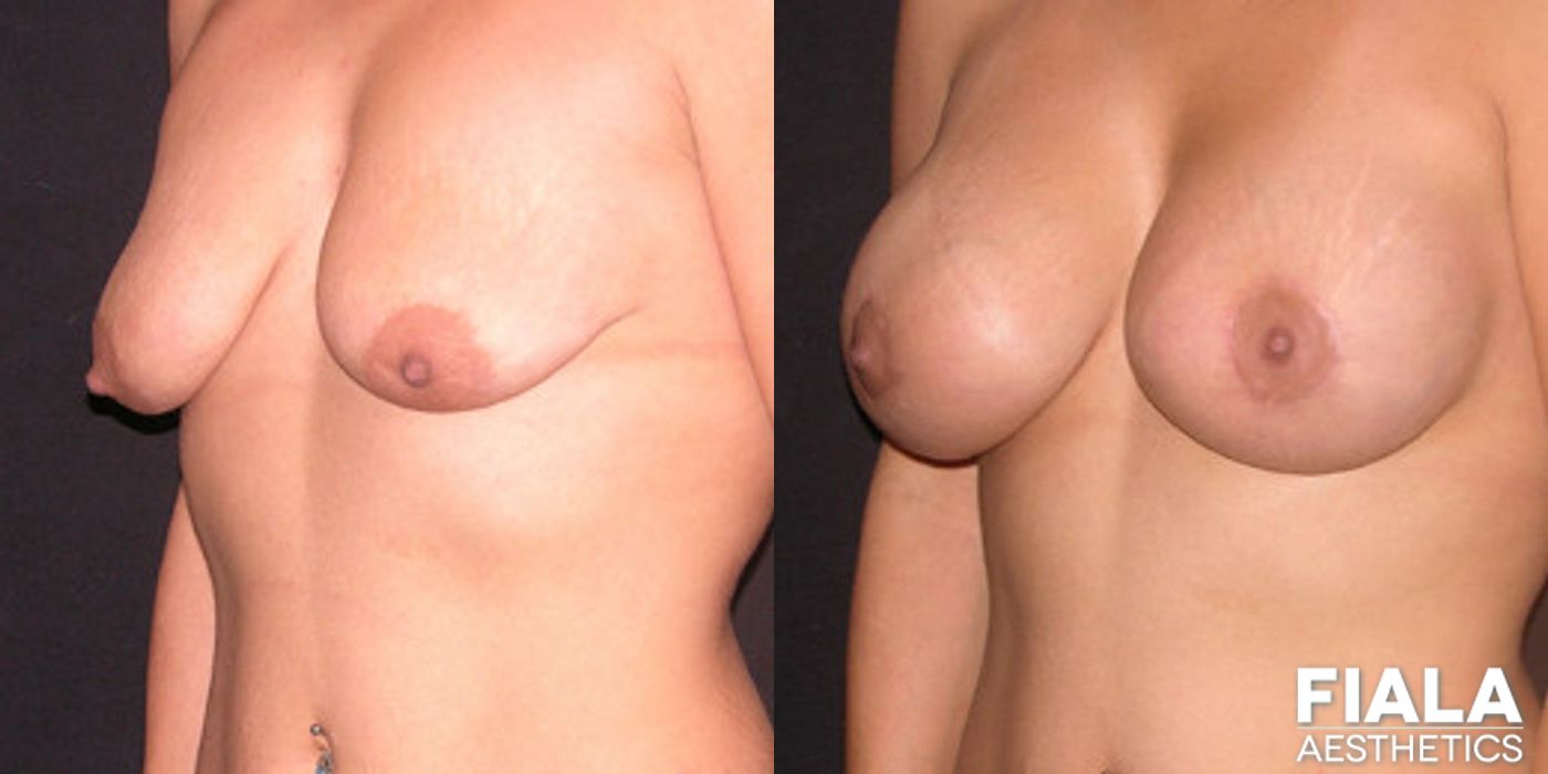 Breast Lift - Case 9177