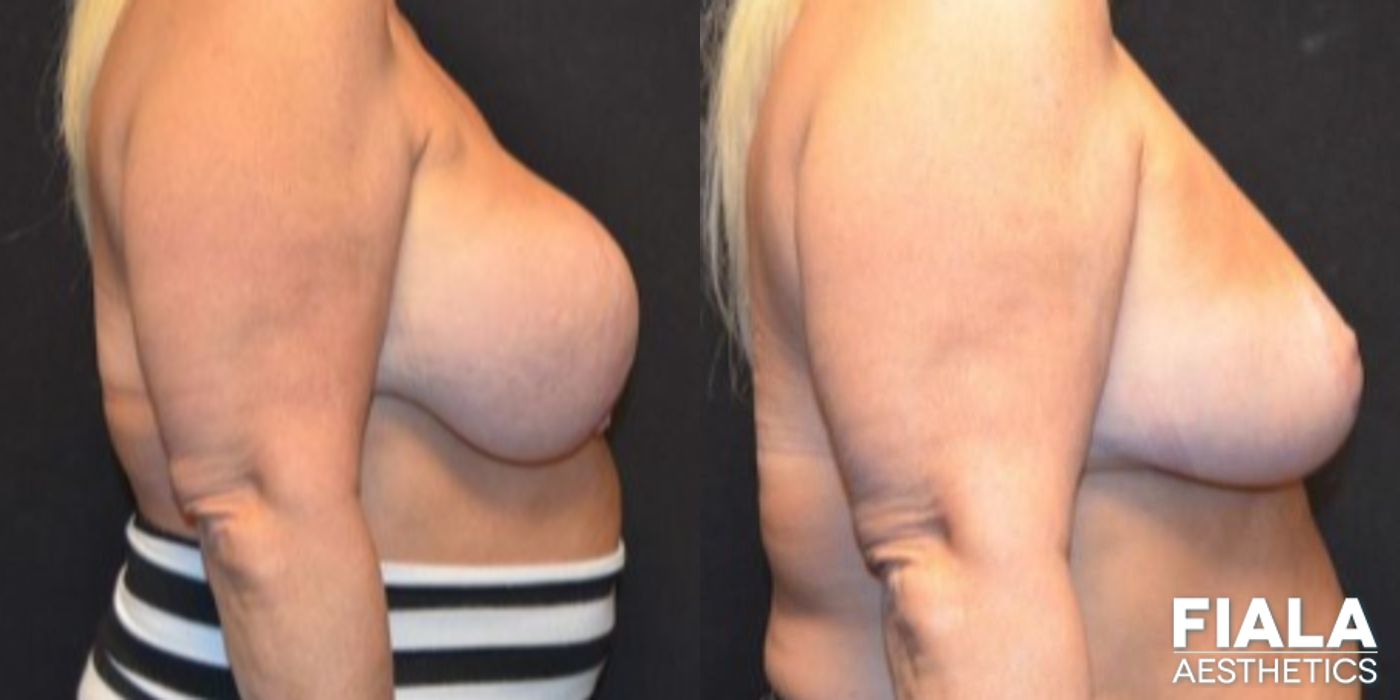 Before and after Breast Revision case 13730 - Angle 3