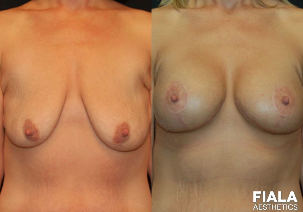 Breast Lift - Case 8962