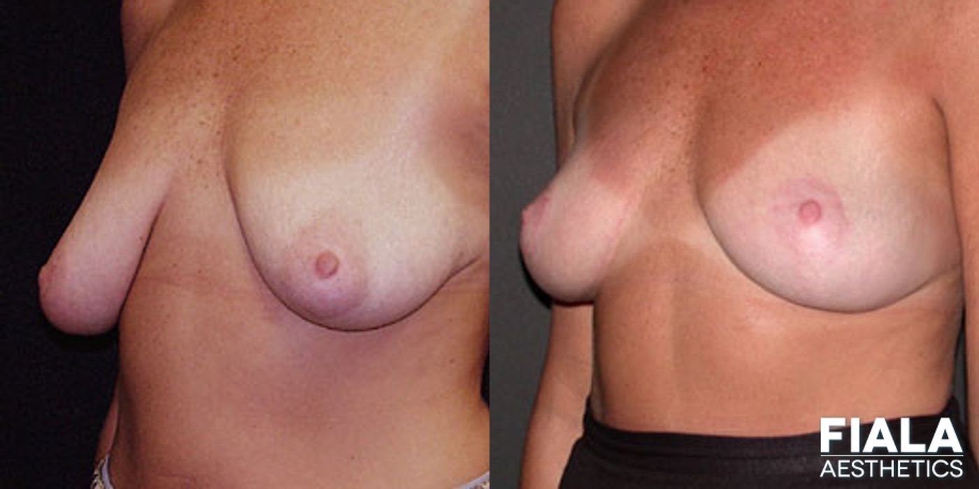 Before and after Breast Lift case 13757 - Angle 2