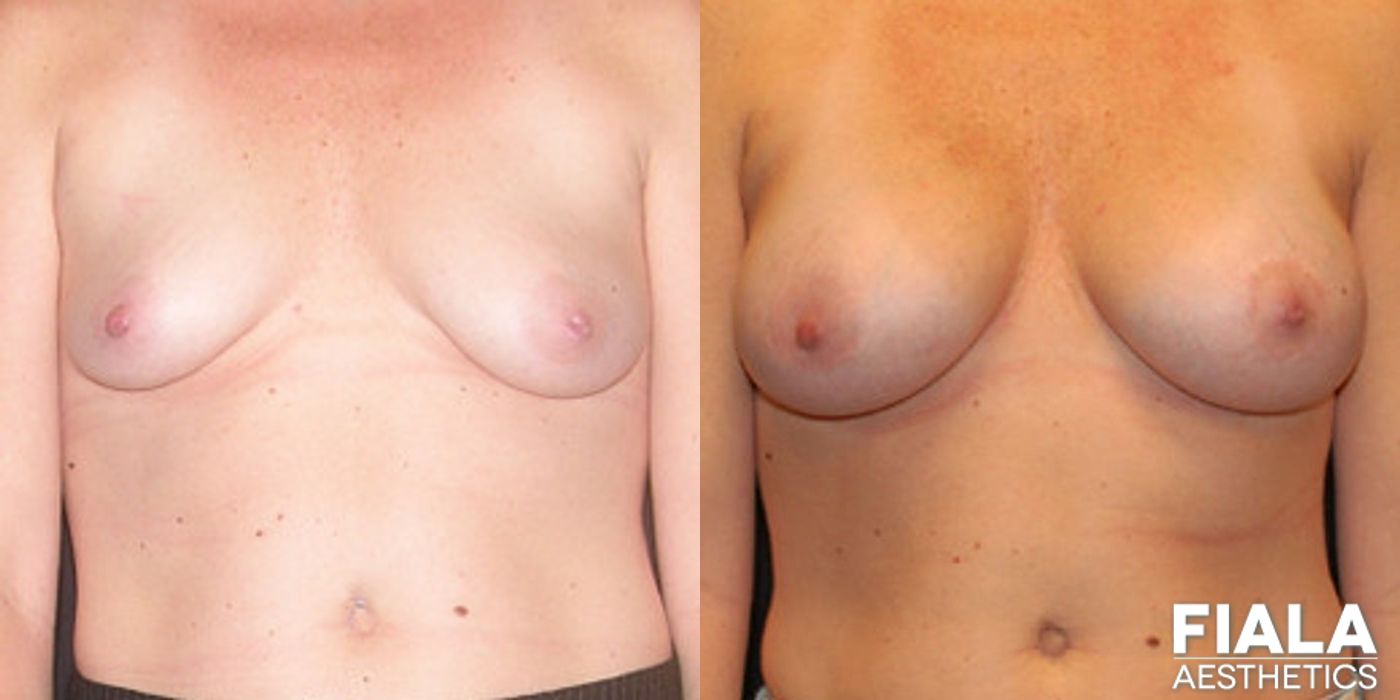 Breast Lift - Case 9163