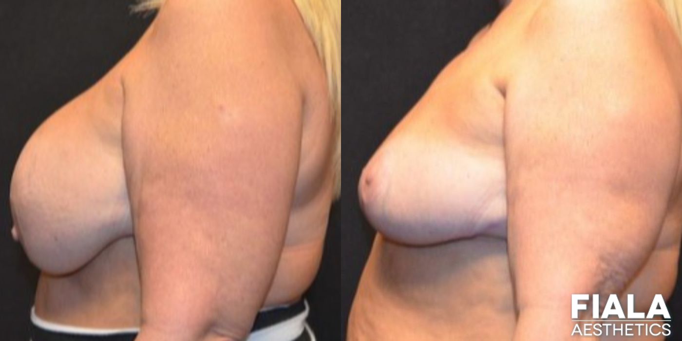 Breast Lift - Thumbnail 5