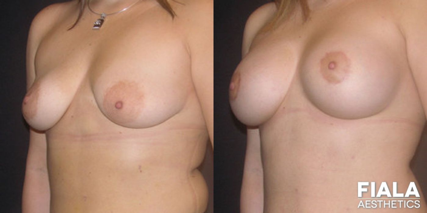 Before and after Breast Lift case 13742 - Angle 2
