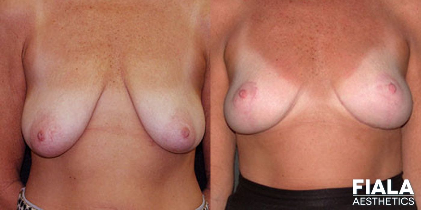 Before and after Breast Lift case 13757