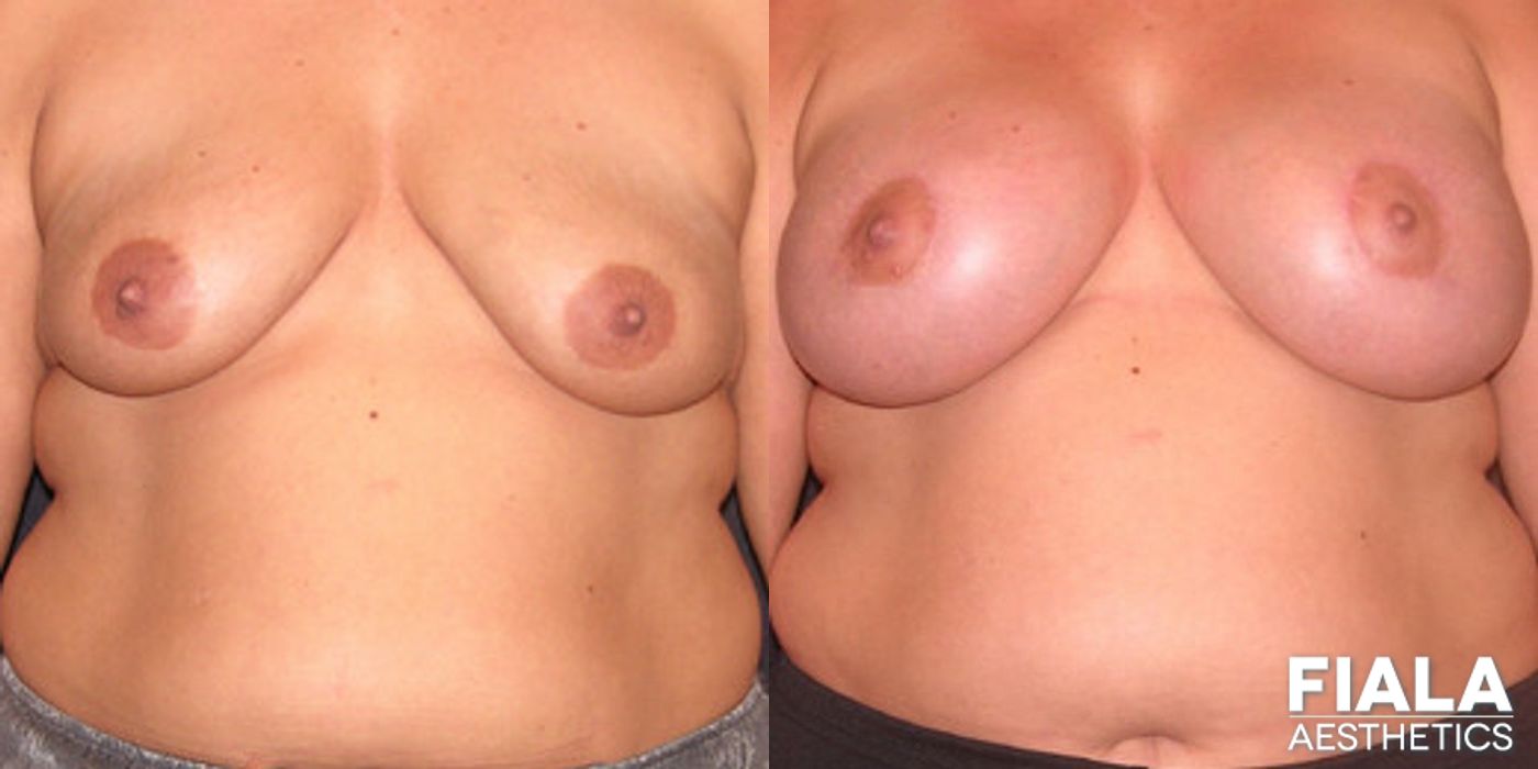 Before and after Breast Lift case 13736