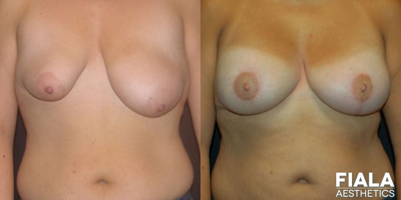 Breast Lift - Thumbnail 2