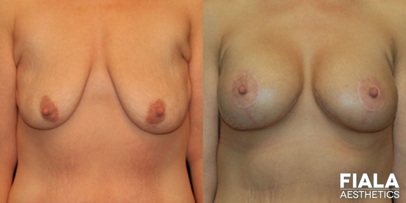 Before and after Breast Lift case 14001