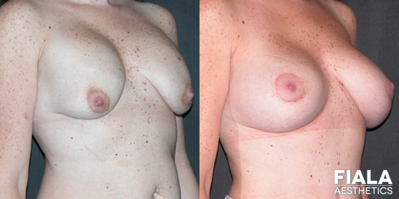 Before and after Breast Revision case 13749 - Angle 2