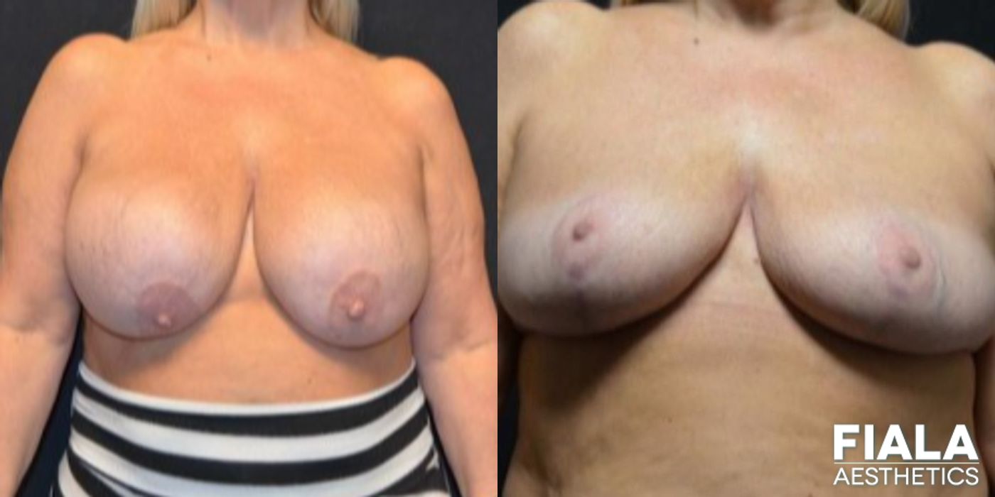 Before and after Breast Revision case 13730
