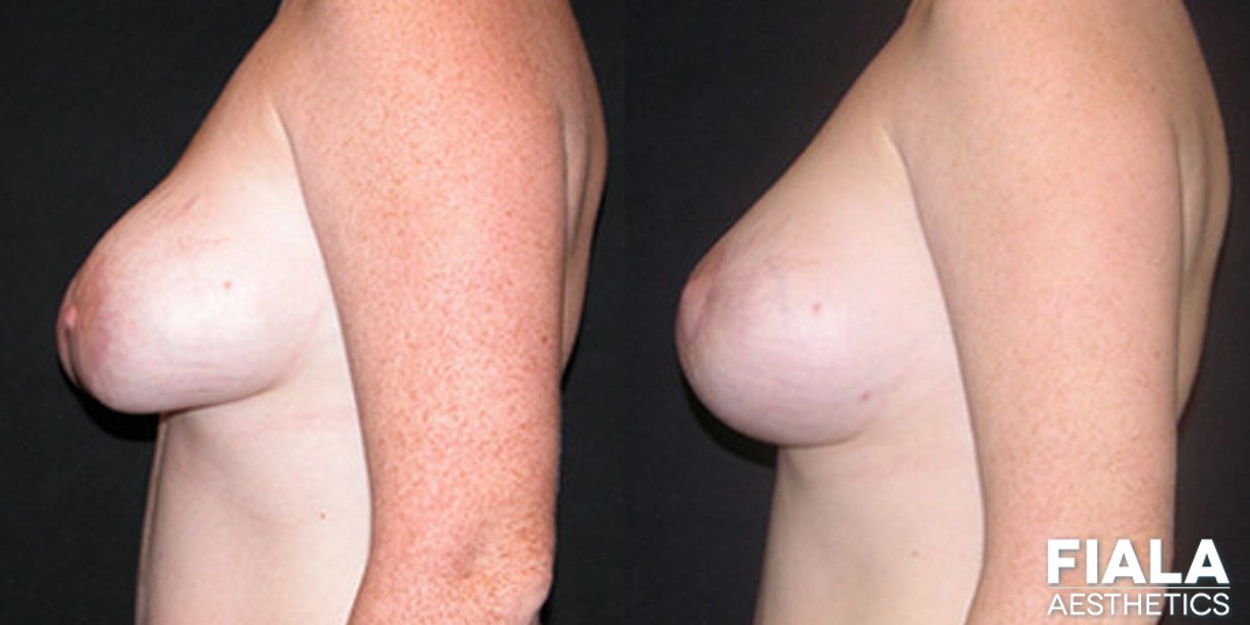 Breast Lift - Thumbnail 2