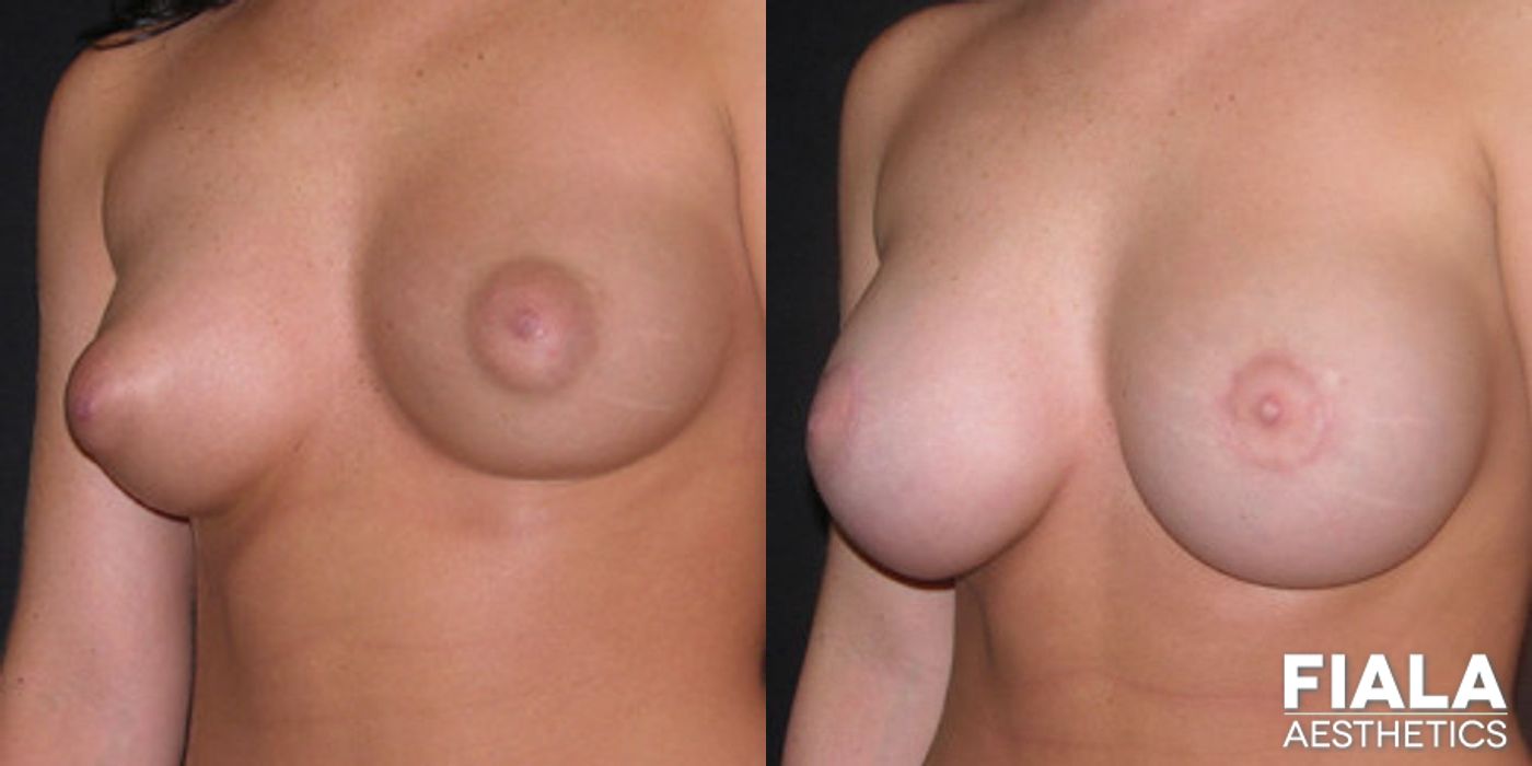 Before and after Breast Lift case 13734