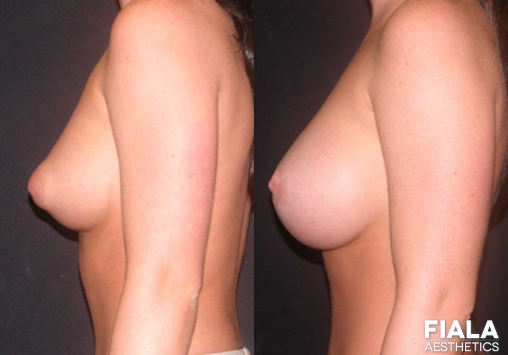 Breast Lift - Thumbnail 2