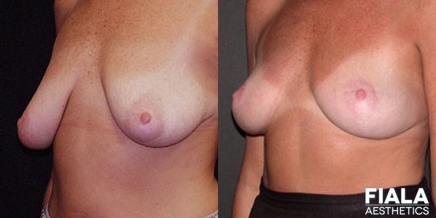 Breast Lift - Thumbnail 2