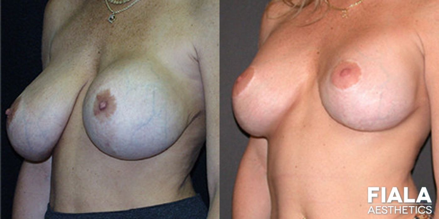 Before and after Breast Revision case 13747