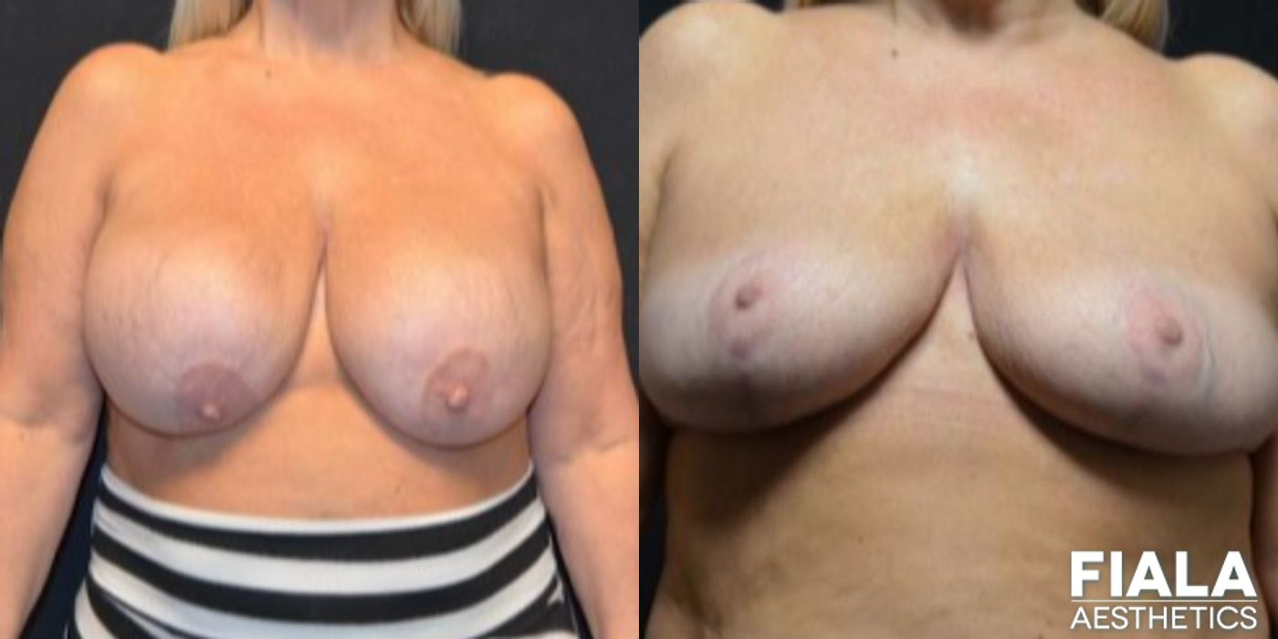Breast Lift - Case 9158