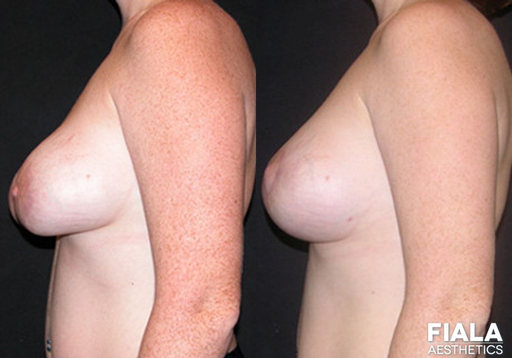 Breast Lift - Thumbnail 2