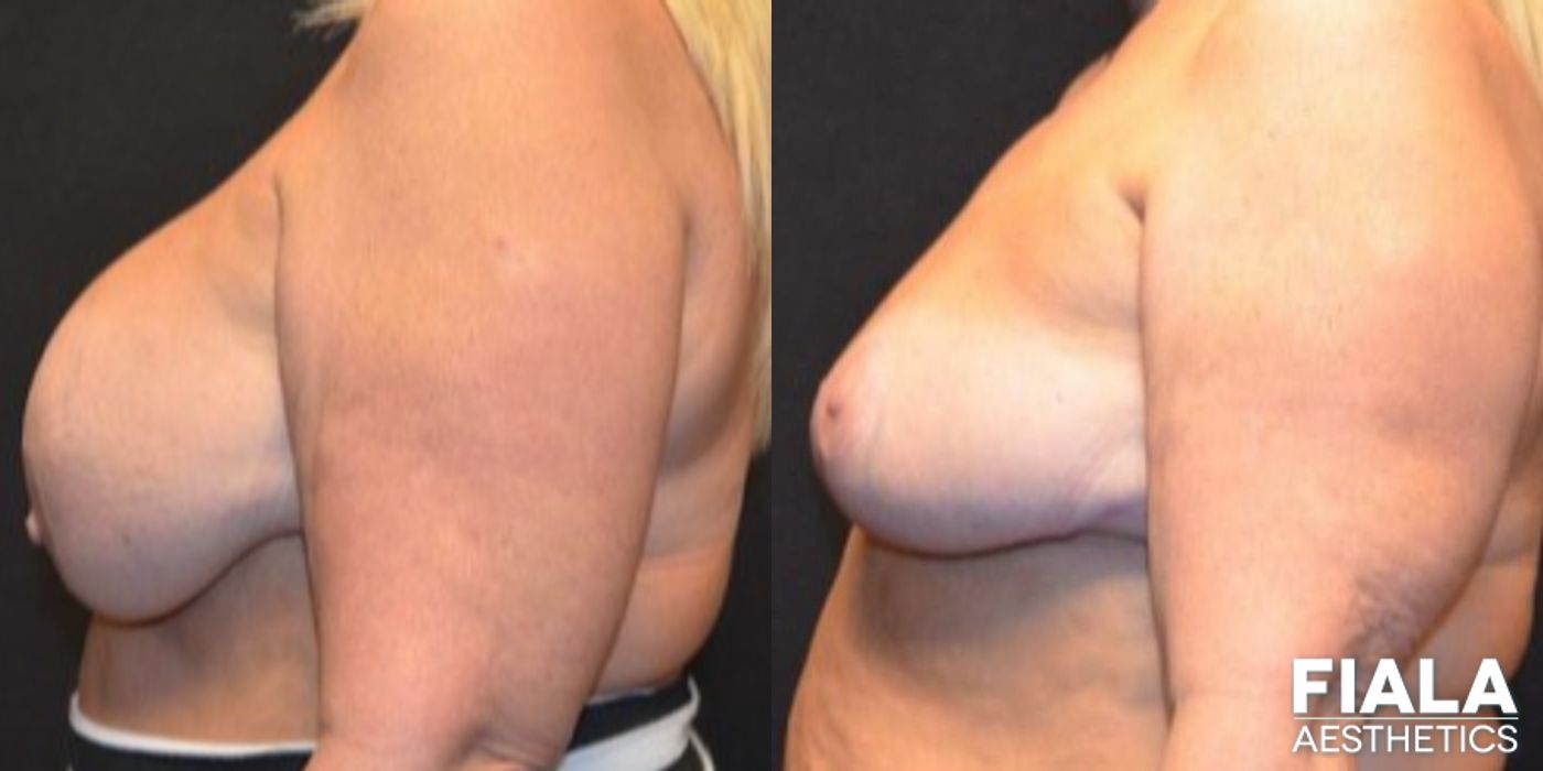 Before and after Breast Revision case 13730 - Angle 5