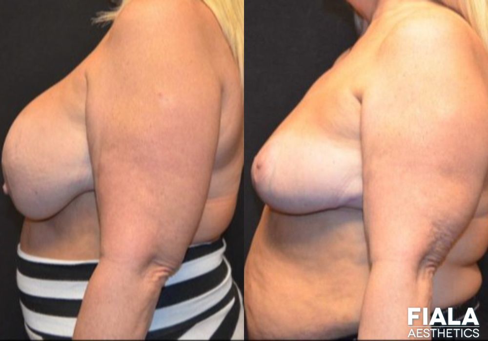 Breast Lift - Thumbnail 4