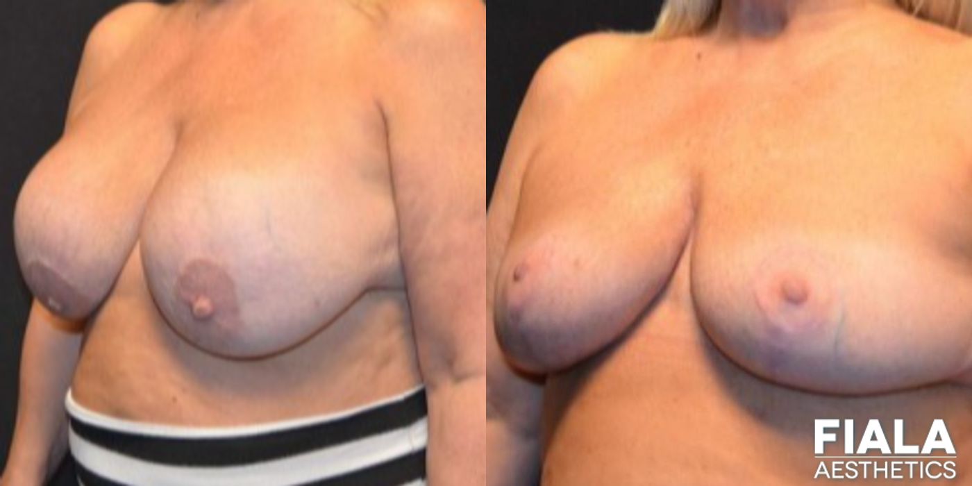 Breast Lift - Thumbnail 4