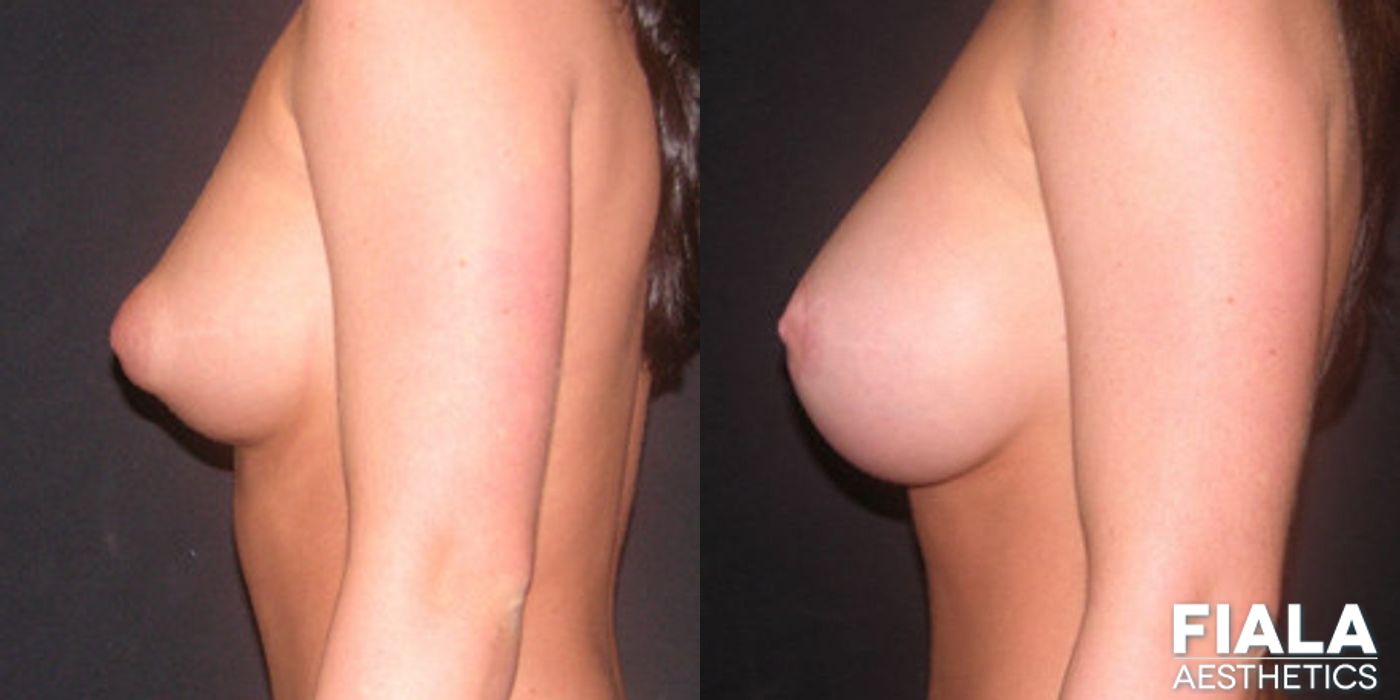 Breast Lift - Thumbnail 2