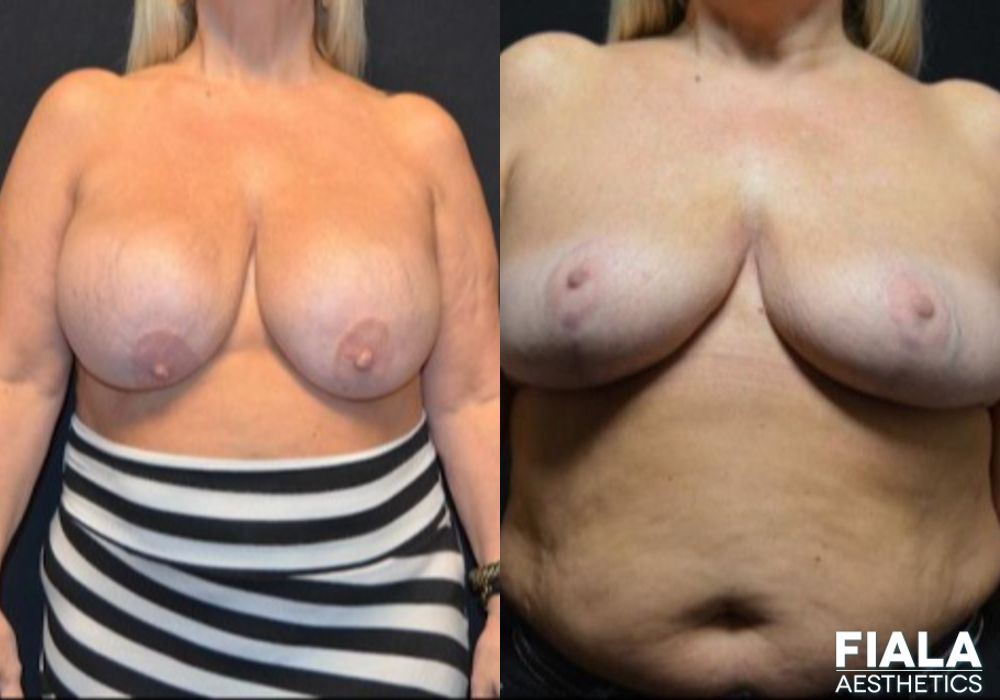 Breast Lift - Case 8968