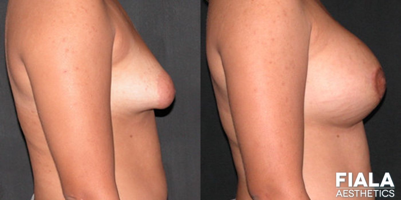 Breast Lift - Case 9176