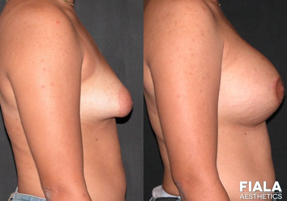 Breast Lift - Thumbnail 2