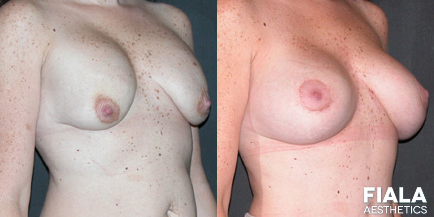 Breast Lift - Thumbnail 2