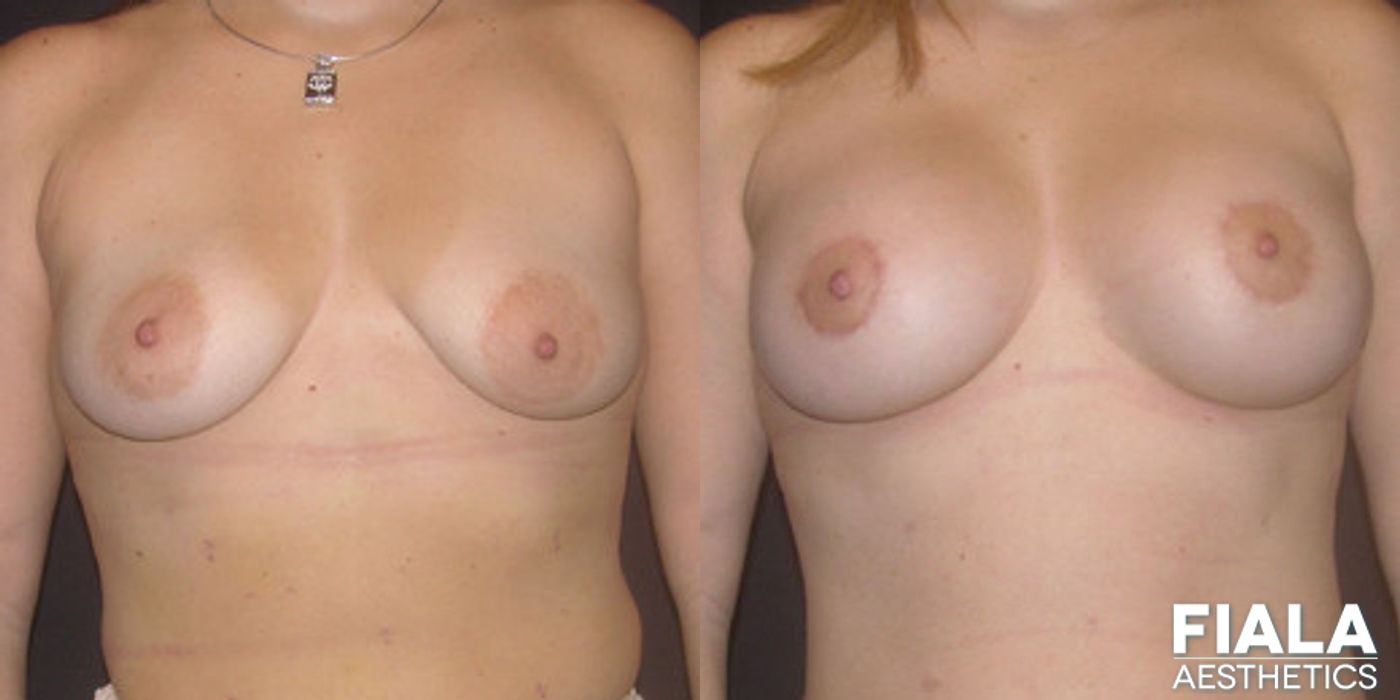 Breast Lift - Case 9167