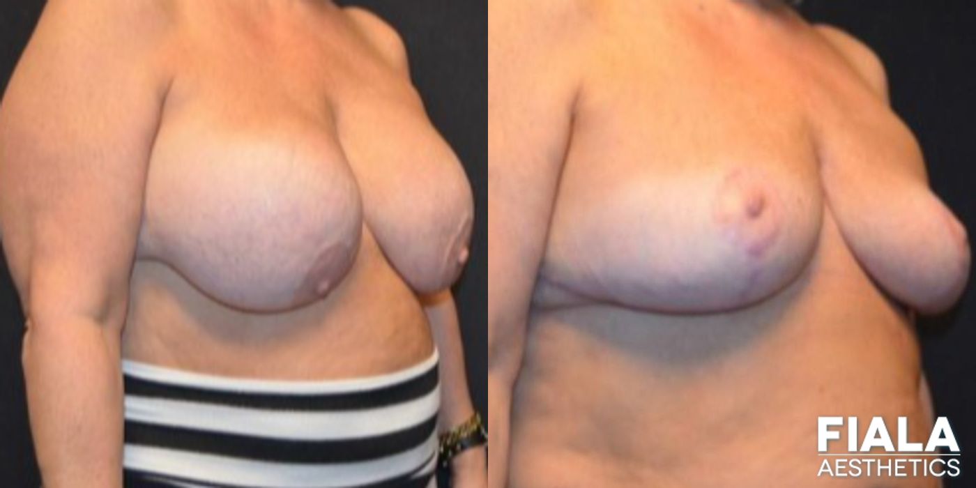 Before and after Breast Revision case 13730 - Angle 2