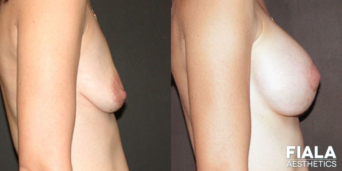 Before and after Breast Lift case 13756 - Angle 2