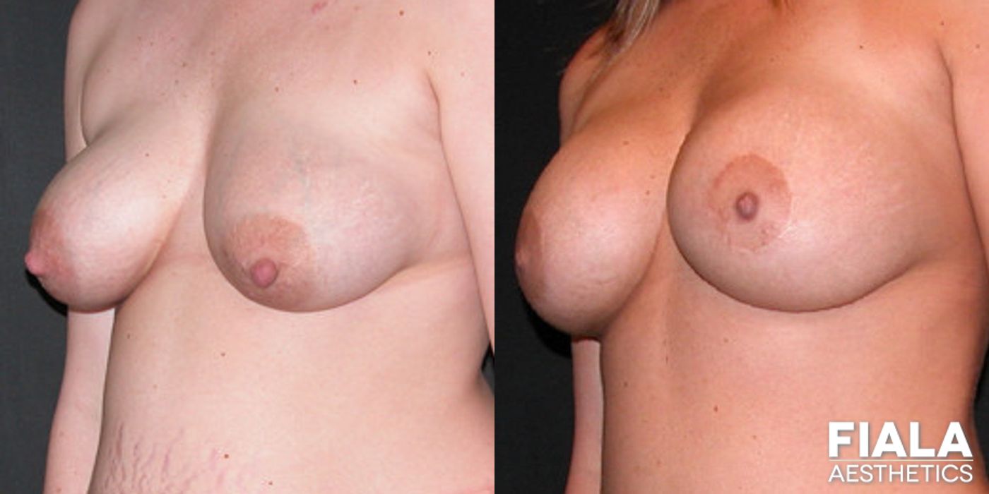 Before and after Breast Lift case 13743 - Angle 2