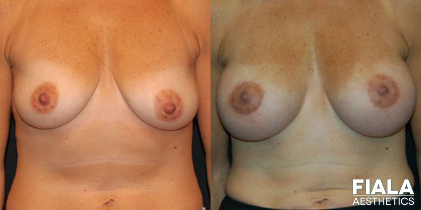 Before and after Breast Lift case 13735