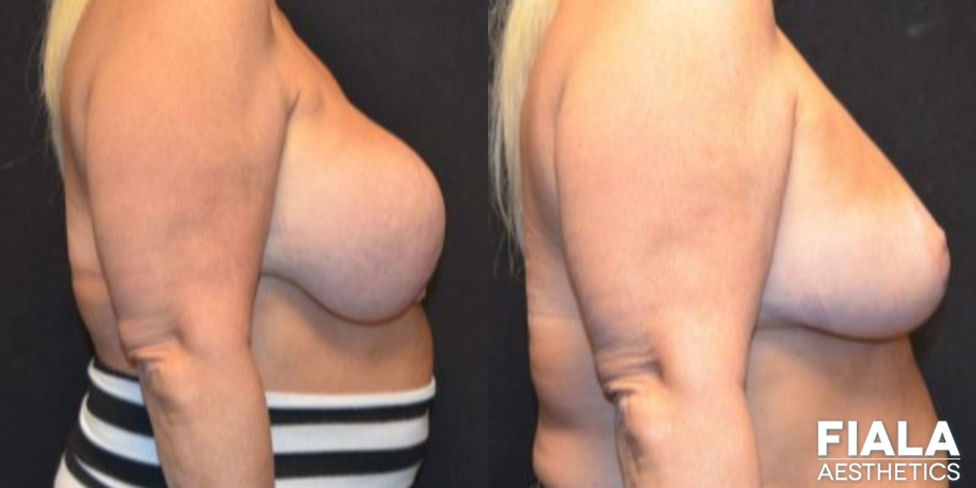 Breast Lift - Thumbnail 3